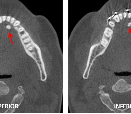 Calcificación en piso de boca