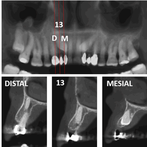 Canino superior impactado evaluado por tomografía maxilofacial