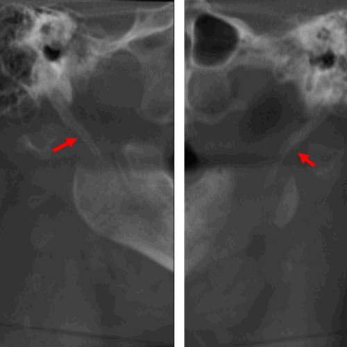 Elongamiento de la apofisis estiloides detecatado por tomografía para implantes dentales