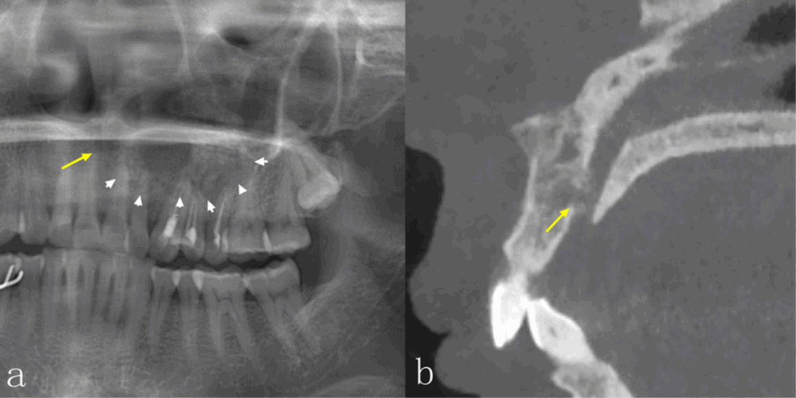 Comparación diagnostica de radiografías panorámicas y tomografía computarizada cone beam