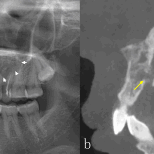Comparación diagnostica de radiografías panorámicas y tomografía computarizada cone beam