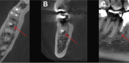Rizólisis de origen inflamatorio