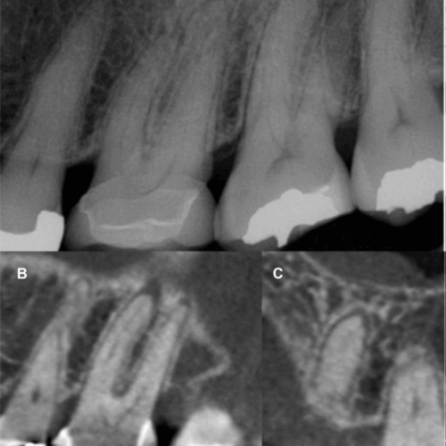 Tomografía para endodoncia y su relevancia en el diagnostico radiológico