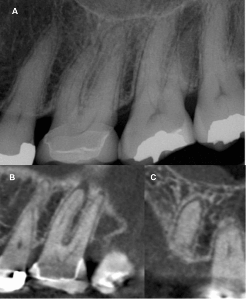 Tomografía para endodoncia y su relevancia en el diagnostico radiológico