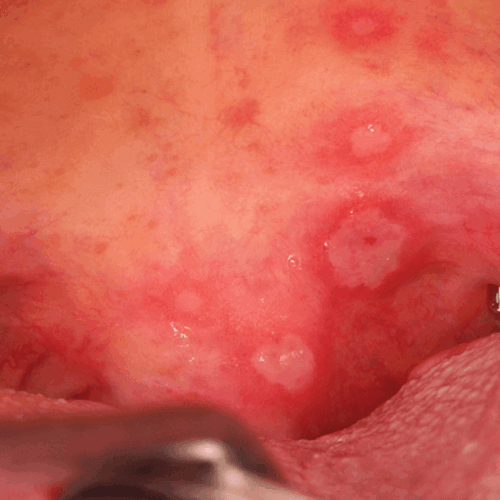 Lesiones benignas frecuentes en la cavidad oral