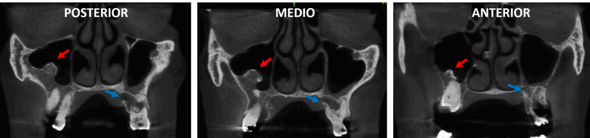 Osteoma en seno maxilar evaluado por tomografía maxilofacial