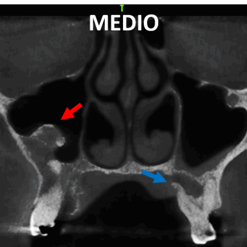 Osteoma en seno maxilar evaluado por tomografía maxilofacial