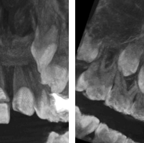Fractura horizontal en incisivo central superior evaluado con tomografía para endodoncia