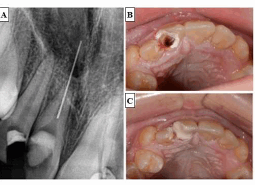 Perforación en fosa nasal durante un tratamiento de endodoncia