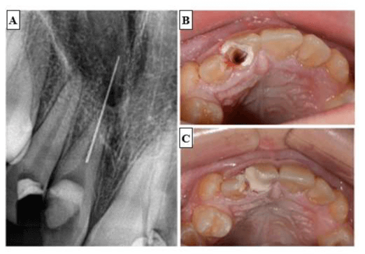 Perforación en fosa nasal durante un tratamiento de endodoncia