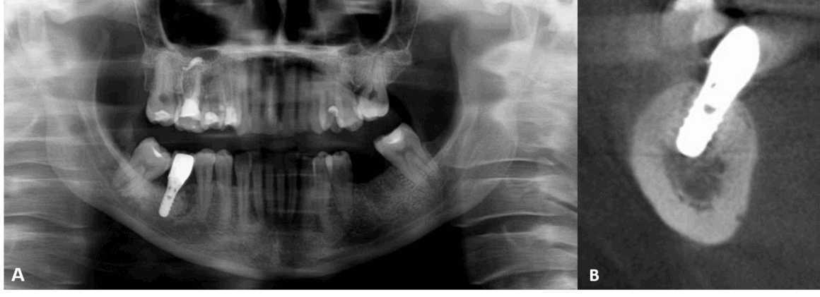 Implante dental colocado en un defecto óseo medular osteoporótico focal evaluado por radiografía panorámica