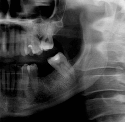 Implante dental colocado en un defecto óseo medular osteoporótico focal evaluado por radiografía panorámica