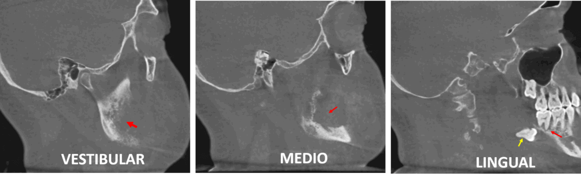 Osteomielitis mandibular asociada a una secuela quirúrgica evaluada por imagenología maxilofacial