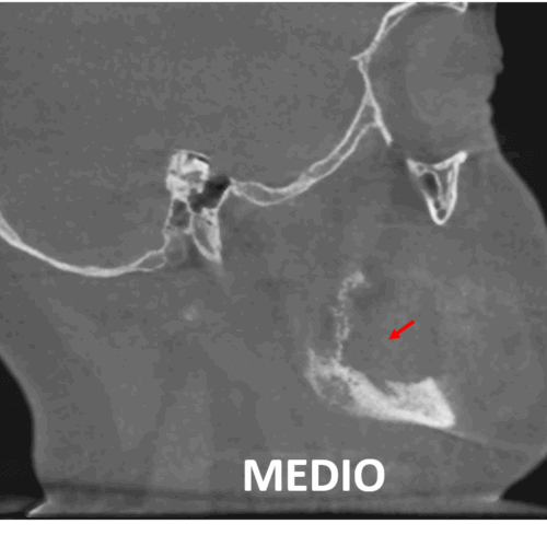 Osteomielitis mandibular asociada a una secuela quirúrgica evaluada por imagenología maxilofacial