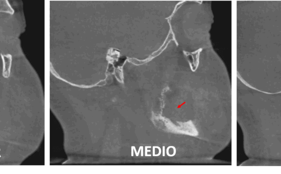 Osteomielitis mandibular asociada a una secuela quirúrgica evaluada por imagenología maxilofacial