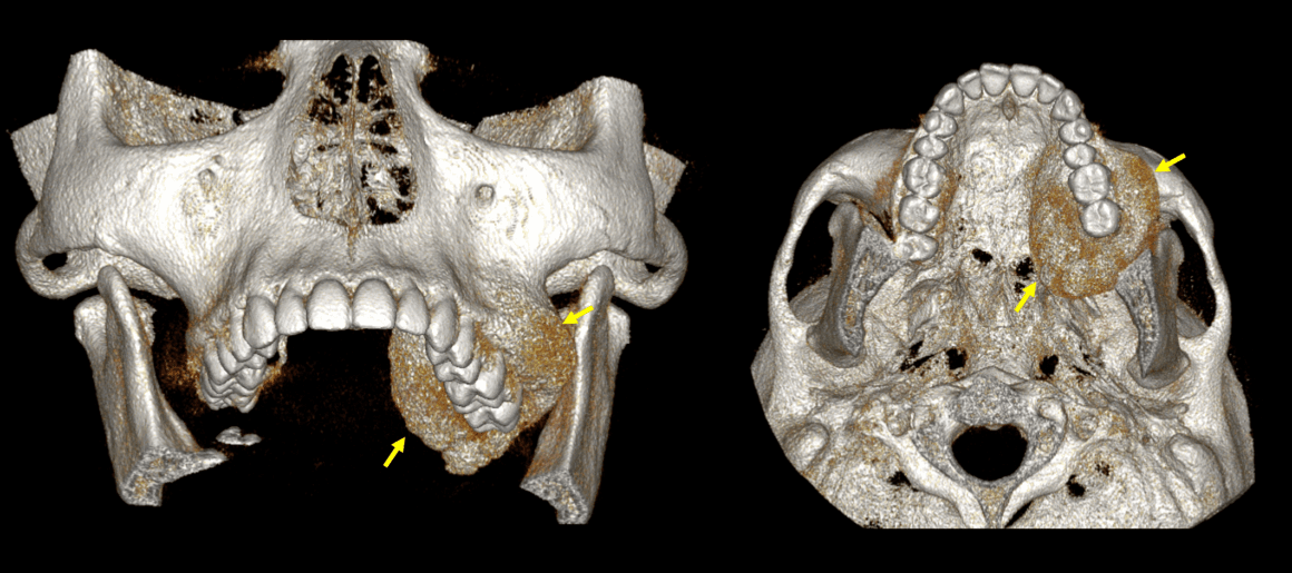 Displasia fibrosa monostótica evaluada por tomografía dental