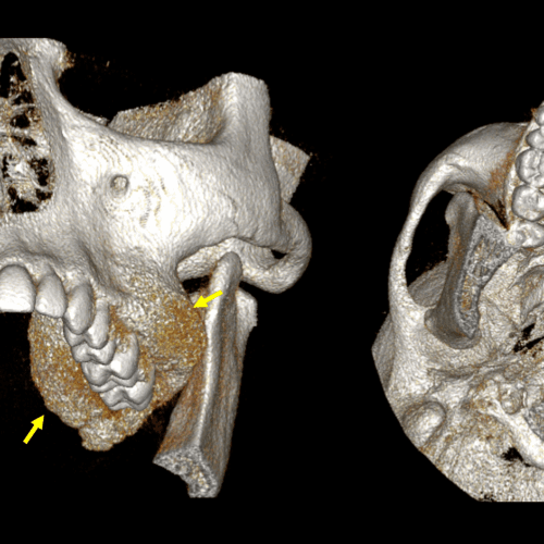 Displasia fibrosa monostótica evaluada por tomografía dental
