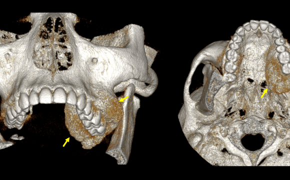 Displasia fibrosa monostótica evaluada por tomografía dental