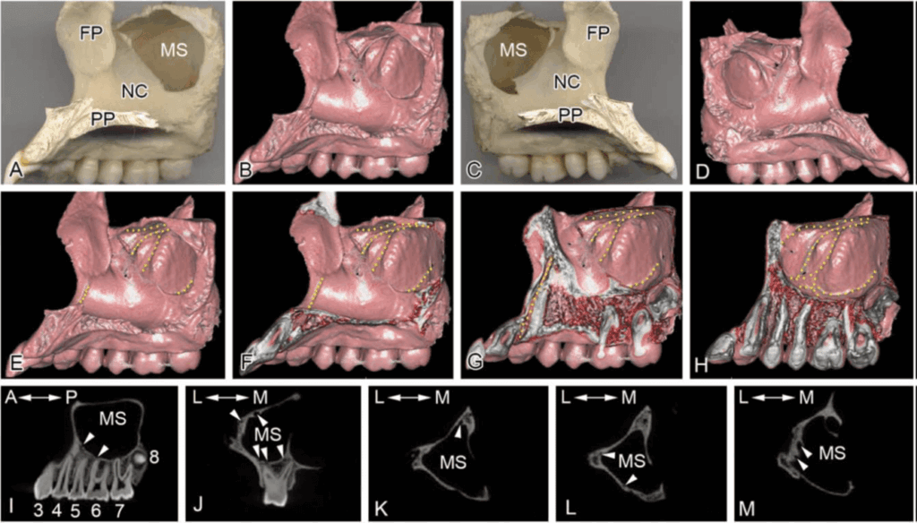 El seno maxilar y su relación con los conductos alveolares superiores  evaluados por tomografía de senos paranasales