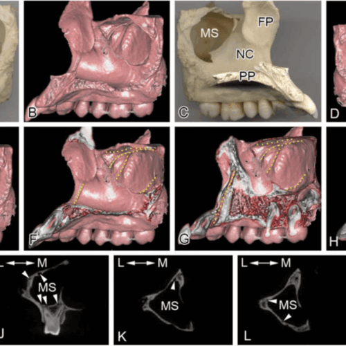 El seno maxilar y su relación con los conductos alveolares superiores  evaluados por tomografía de senos paranasales