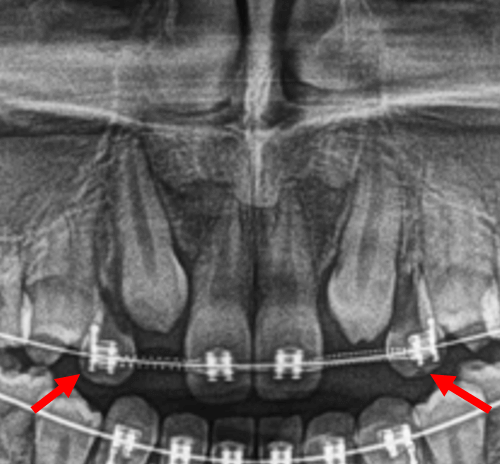 Transposición dentaria bilateral de caninos superiores observados en la radiografía panorámica