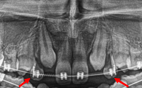 Transposición dentaria bilateral de caninos superiores observados en la radiografía panorámica