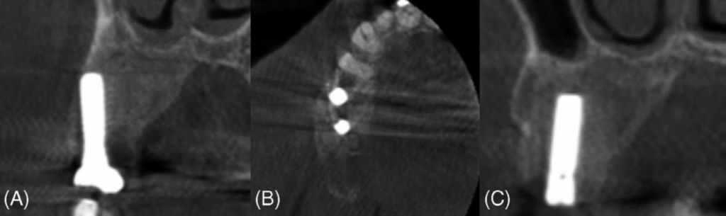 Colocación de implantes en un paciente con displasia fibrosa evaluado por tomografía maxilofacial
