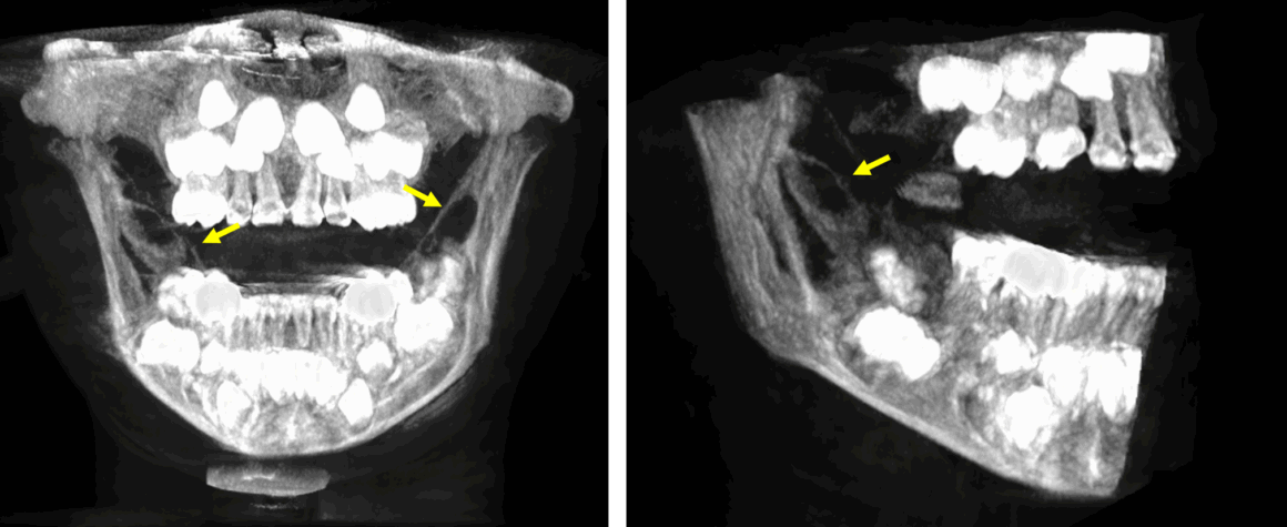 Aparente lesión tumoral de un paciente pediátrico evaluado por tomografía dental para niños