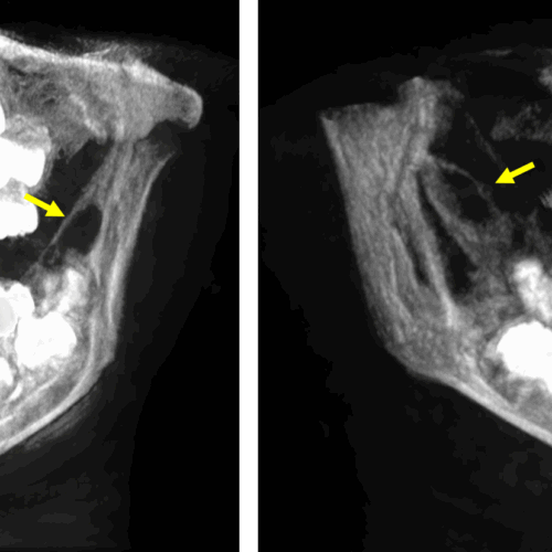Aparente lesión tumoral de un paciente pediátrico evaluado por tomografía dental para niños