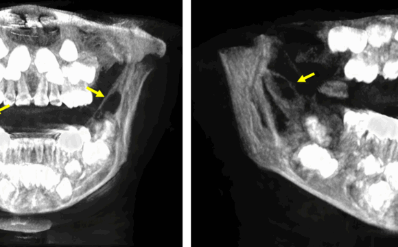 Aparente lesión tumoral de un paciente pediátrico evaluado por tomografía dental para niños