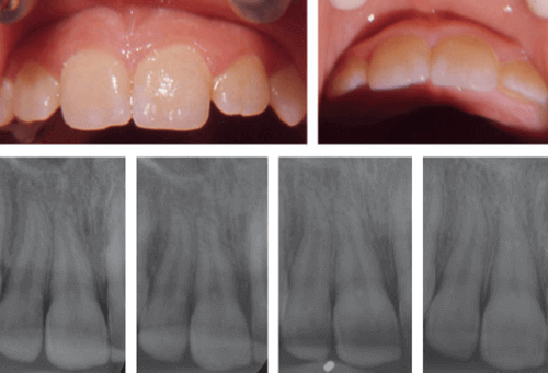 Complicaciones periodontales por concusión y subluxación en la dentición permanente evaluados con radiografías periapicales