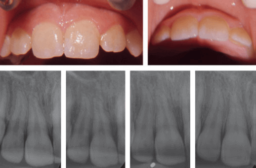 Complicaciones periodontales por concusión y subluxación en la dentición permanente evaluados con radiografías periapicales
