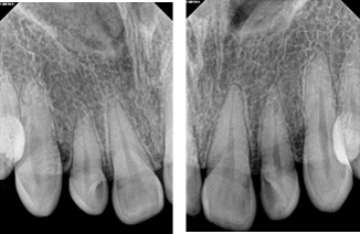 Microdoncia de incisivos laterales evaluado por radiografías periapicales y panorámica
