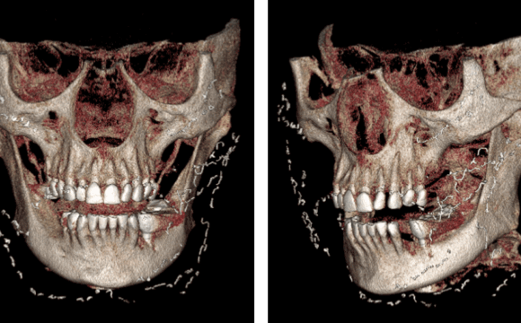 Hilos de filamento de oro como hallazgo imagenológico en la tomografía para implantes dentales