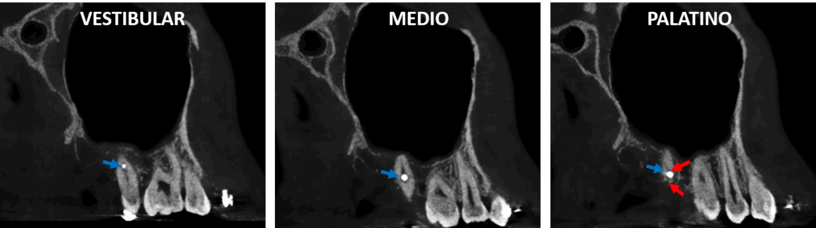 Perforación radicular por material de osteosíntesis detectado por tomografía dental