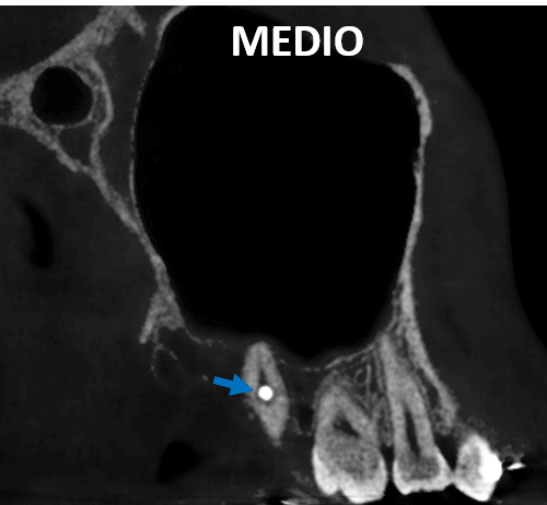 Perforación radicular por material de osteosíntesis detectado por tomografía dental