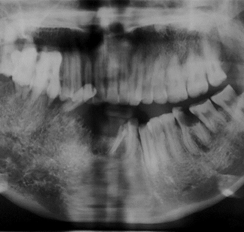 Malformación arteriovenosa en la mandíbula