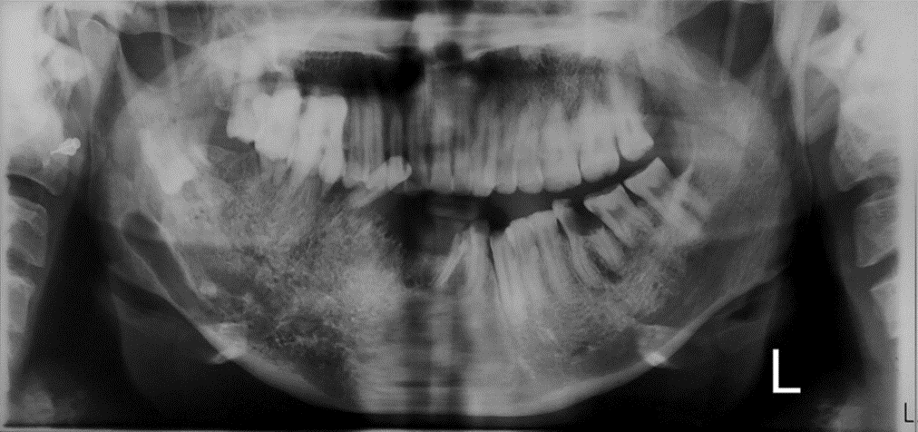 Malformación arteriovenosa en la mandíbula