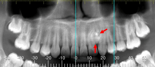 Odontoma compuesto evaluado por tomografía para dientes impactados