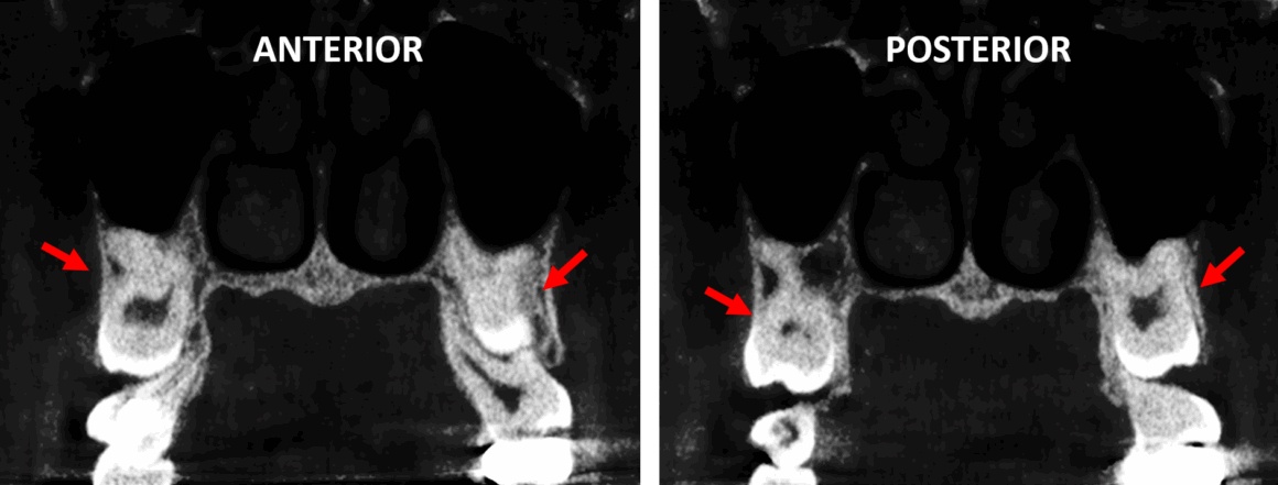 Impactacion vertical de terceros molares superiores evaluado por tomografía para dientes impactados
