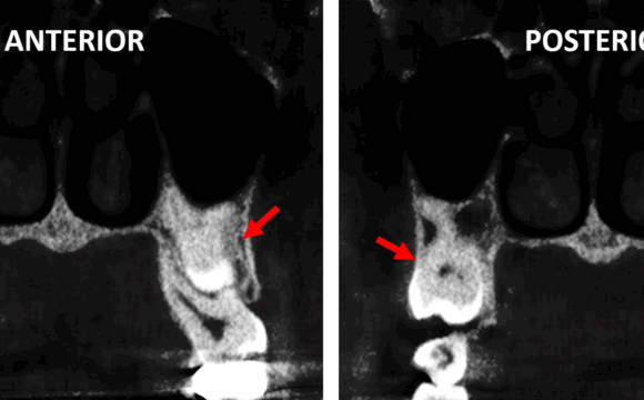 Impactacion vertical de terceros molares superiores evaluado por tomografía para dientes impactados