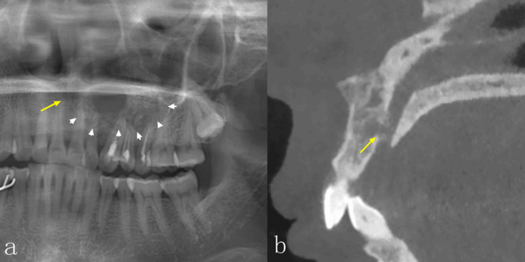 Comparación entre la precisión diagnostica de la radiografía panorámica y la tomografía computarizada de haz cónico