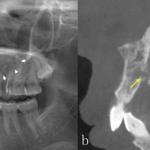 Comparación entre la precisión diagnostica de la radiografía panorámica y la tomografía computarizada de haz cónico