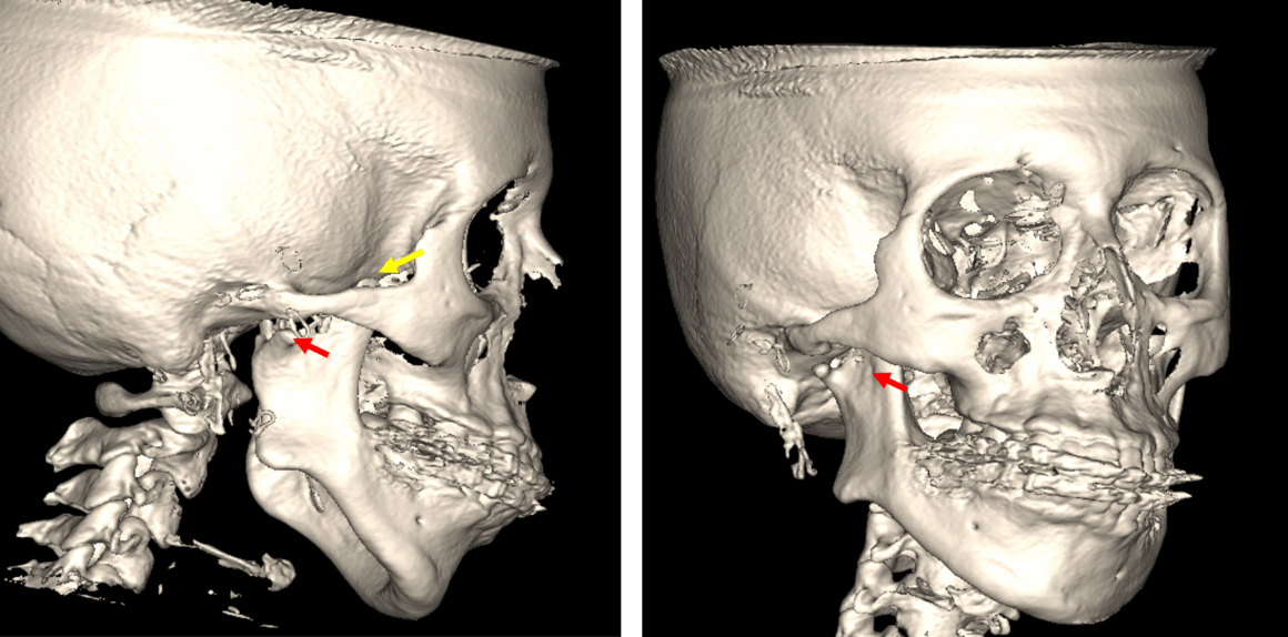 Hipoplasia Condilar evaluada por tomografía para ATM