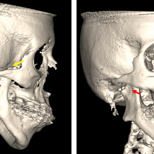 Hipoplasia Condilar evaluada por tomografía para ATM