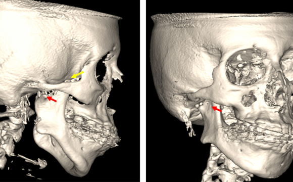 Hipoplasia Condilar evaluada por tomografía para ATM