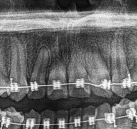 Probable rizólisis por tratamiento de ortodoncia