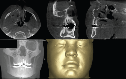 Fractura del proceso cigomático maxilar evaluado con tomografía maxilofacial