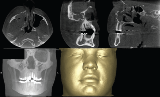 Fractura del proceso cigomático maxilar evaluado con tomografía maxilofacial