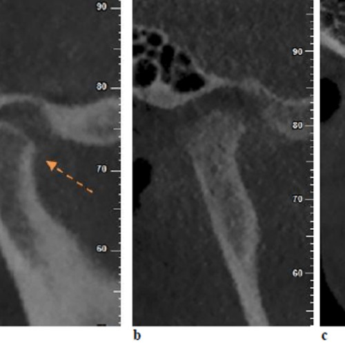 Cambios óseos en ATM evaluados con tomografía maxilofacial (cone beam)